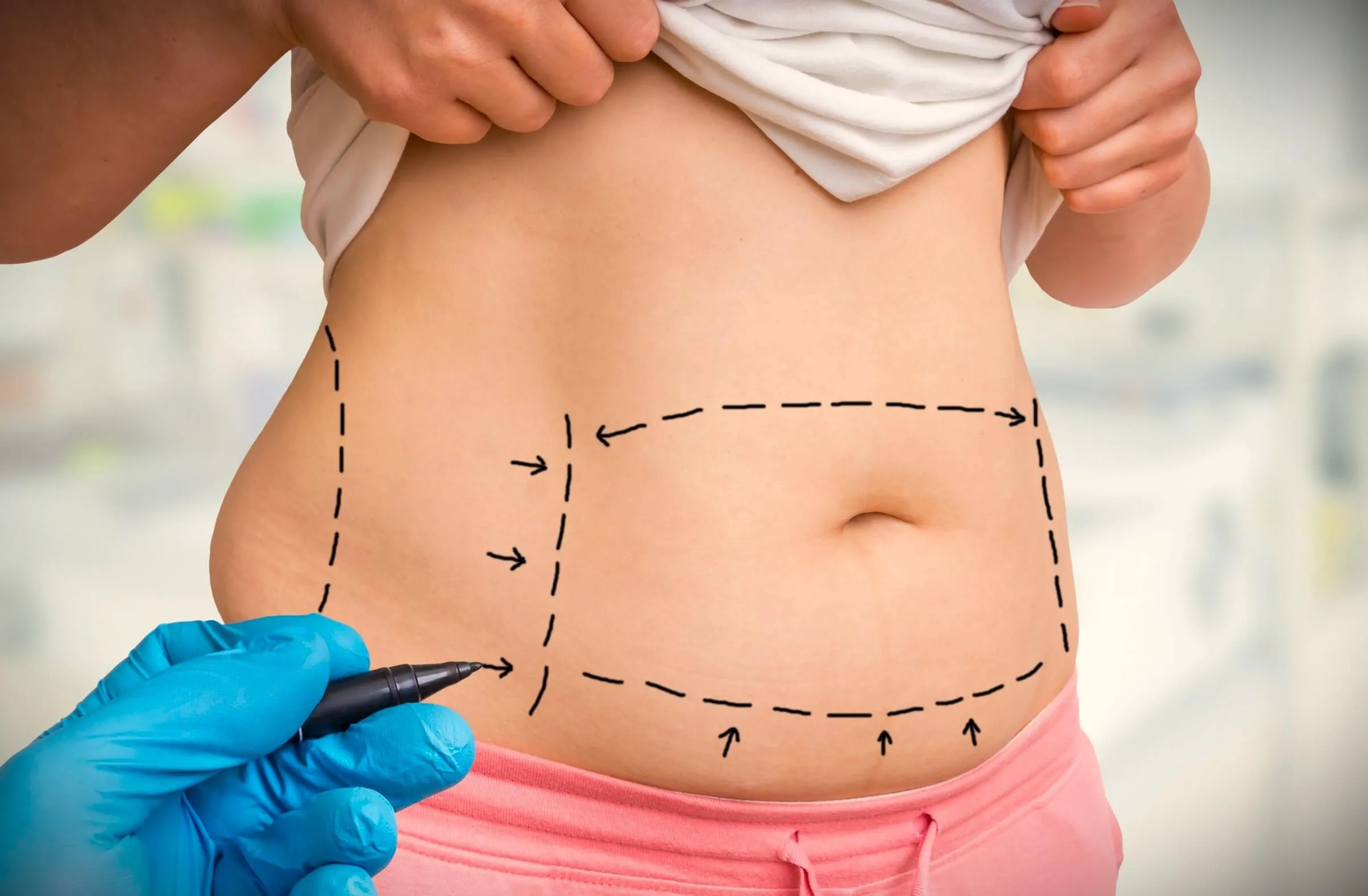 Abdominoplastia Circunferencial Abdome Dr. Felipe Zampieri Cirurgião Plástico