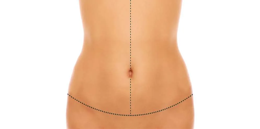 Abdominoplastia em âncora Abdome Dr. Felipe Zampieri Cirurgião Plástico