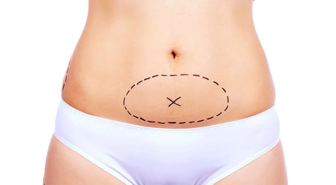 Miniabdominoplastia Abdome Dr. Felipe Zampieri Cirurgião Plástico