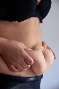 Abdominoplastia