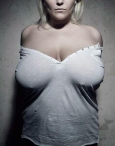 Mamoplastia Redutora