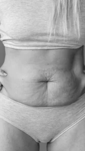 Abdominoplastia
